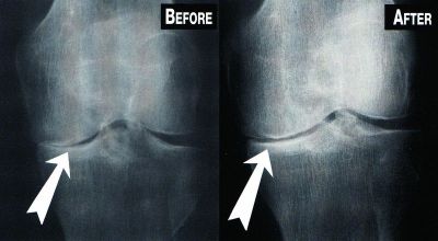 Knee Treatment